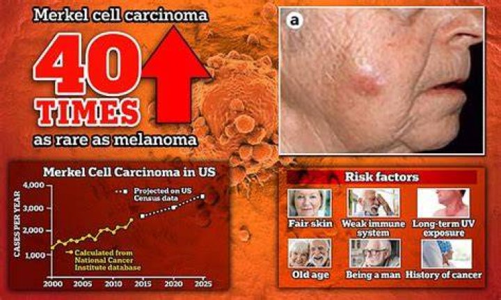 Jimmy Buffett's Cause of Death : Revealed as Merkel Cell Skin Cancer - SarkariResult