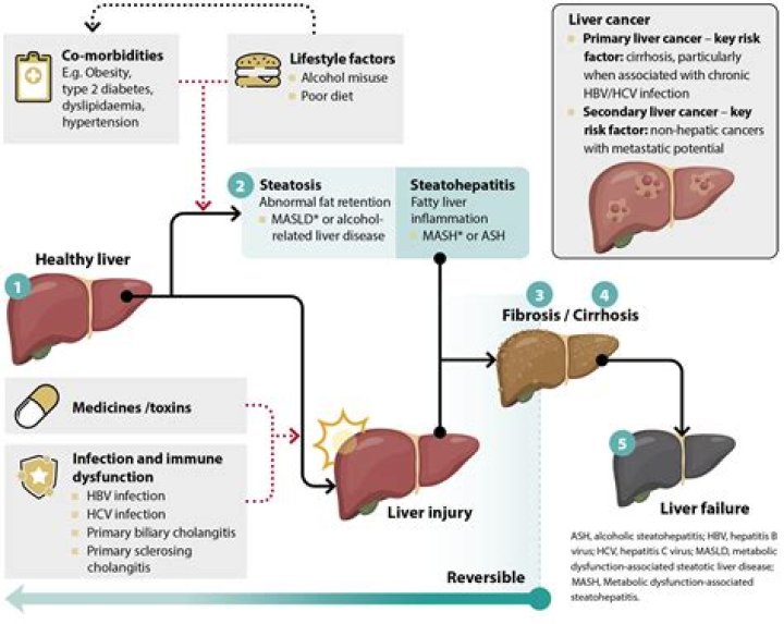 Joshua Block Liver Failure: Illness And Health Update 2024 - SarkariResult