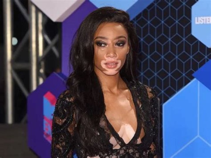 Winnie Harlow Height, Weight, Measurements, Bra Size, Shoe Size