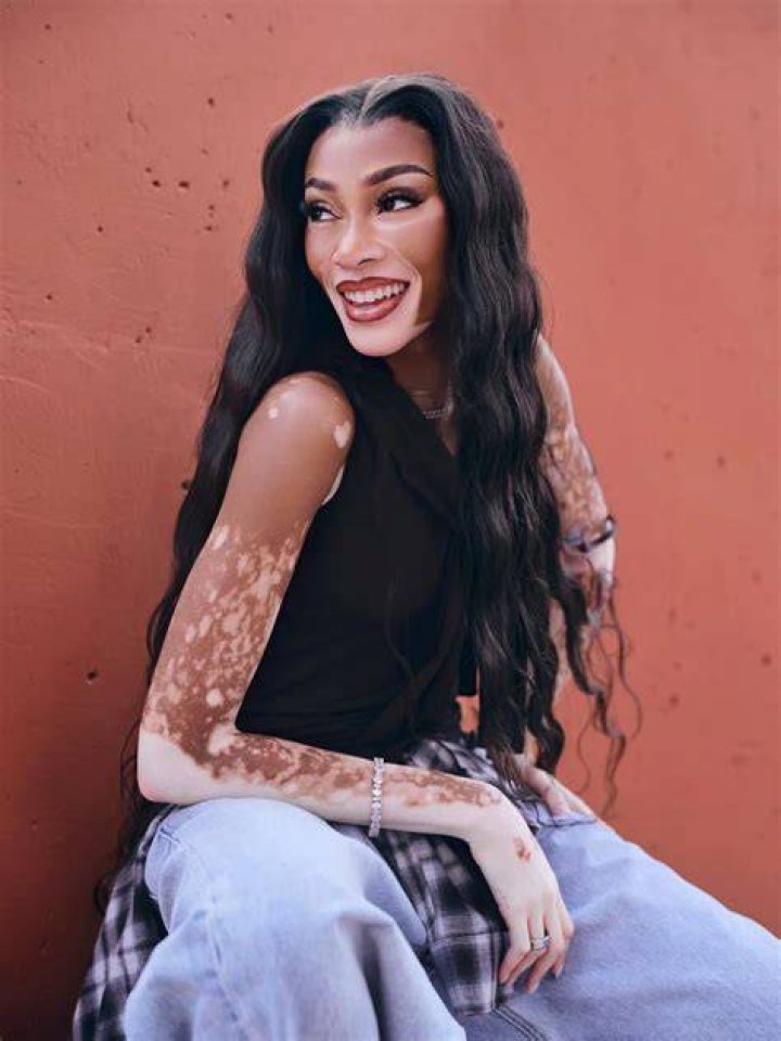 Winnie Harlow Winnie Harlow
